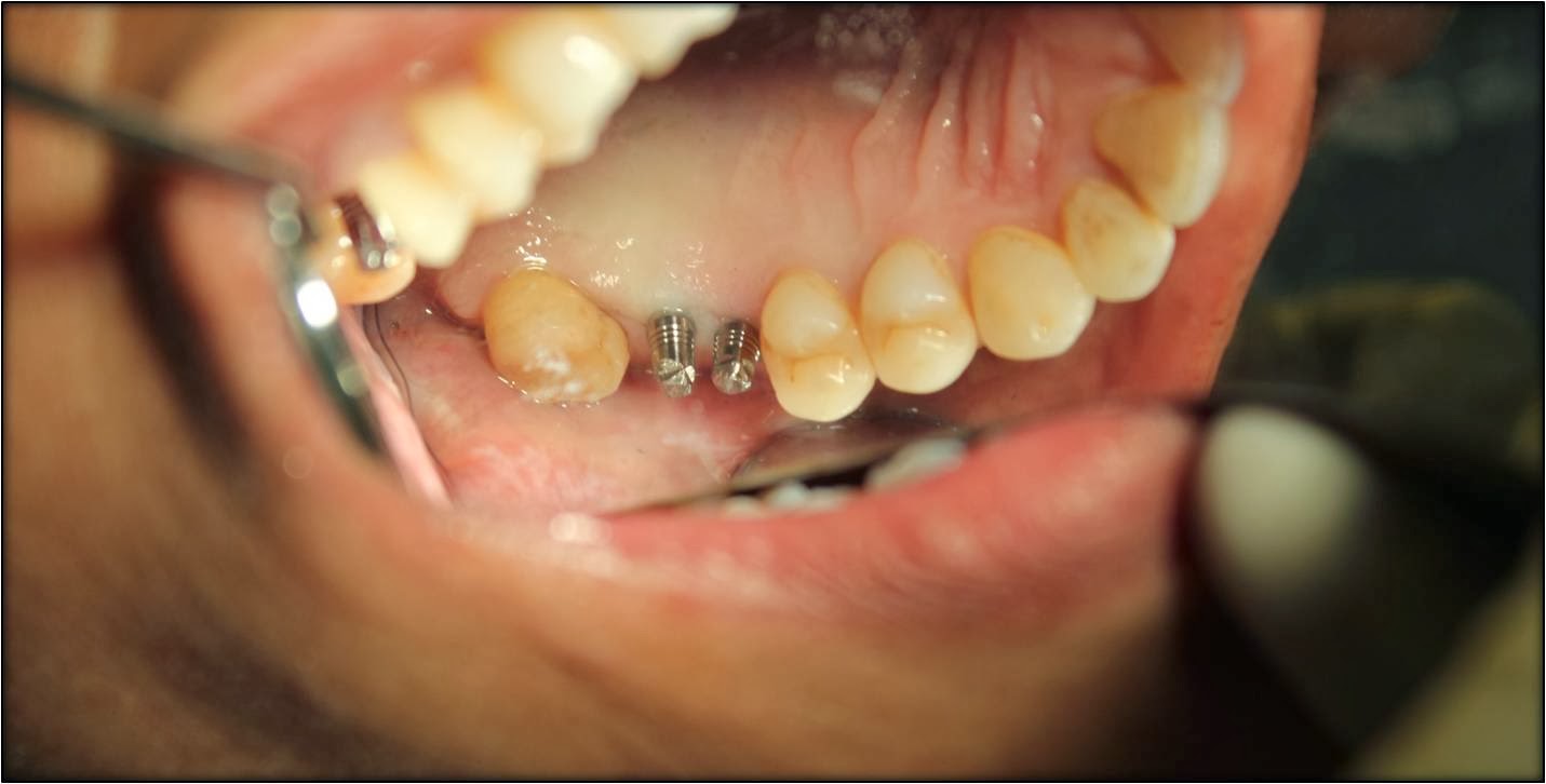 Zirconium crowns cost in INDIA