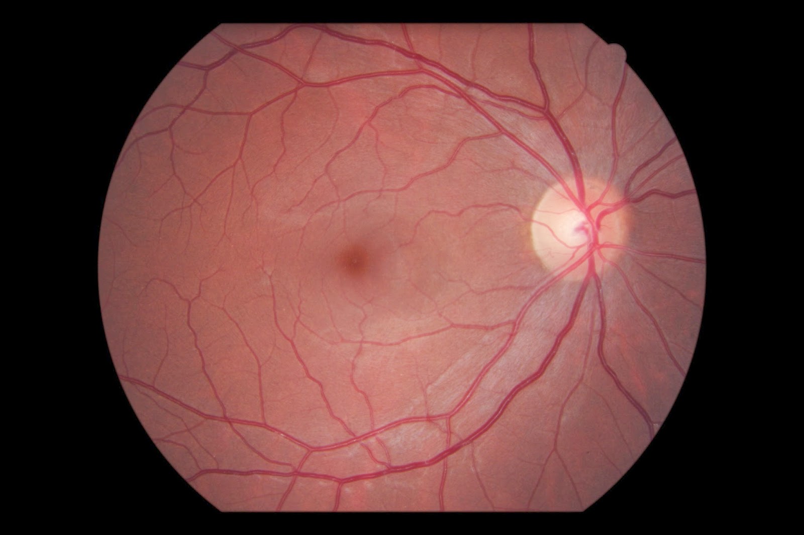 The Patient's Guide to Optic Nerve Drusen Eyedolatry