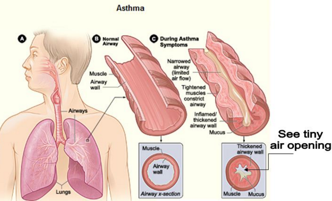 Asthma ki Bimari ke liye Aushdhiya Upay