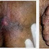 Obat Resep Dokter Untuk Ambeien thumbnail