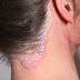 Impact of Psoriasis on Psychological life and its control through Homeopathy
