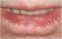 lip lips actinic skin sun damage cancer care lower symptoms cheilitis keratosis bottom scale scaly