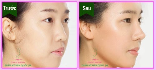 Hình ảnh nâng mũi s line 1 hinh-anh-nang-mui-s-line-1