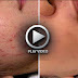 How To Remove Pimples And Marks - Video Tutorial