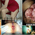 Obat AmbeJOSS dan Penyakit di Anus (Wasir) thumbnail