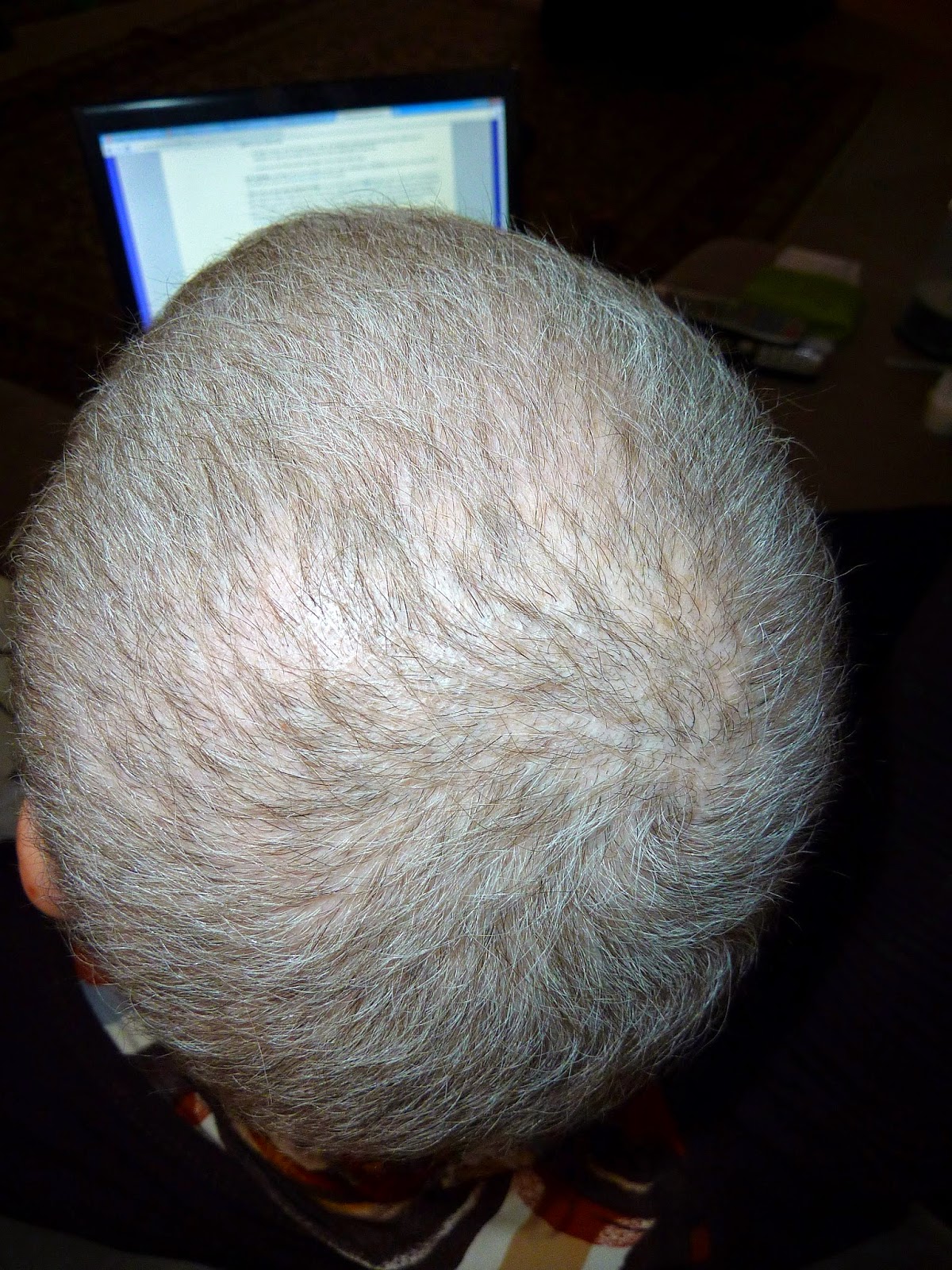 Anncredible: Hair Growth Progression after Chemo- Six Months with UPDATE!