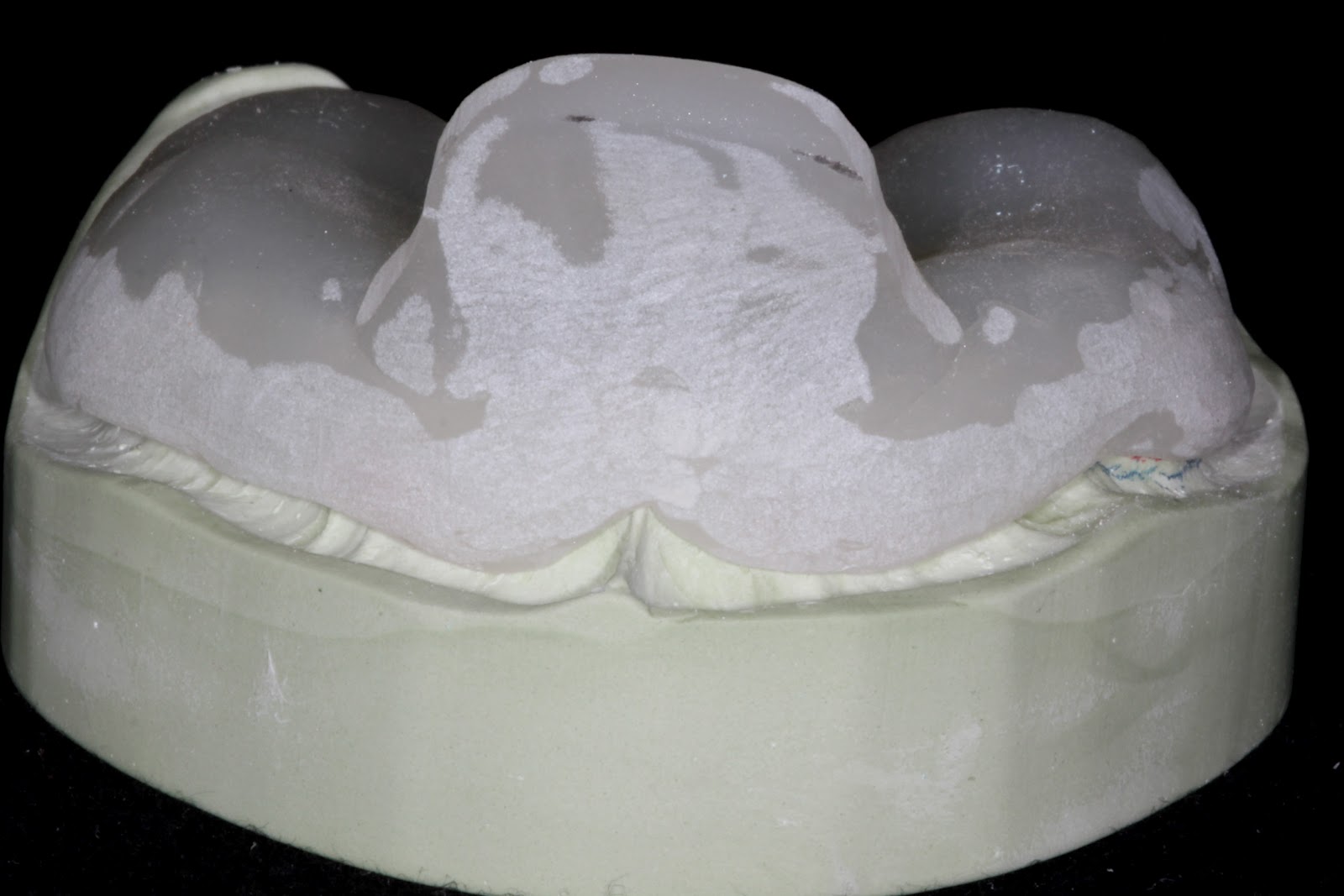 Boise Idaho Prosthodontics Edentulous Custom Tray for PVS Impression