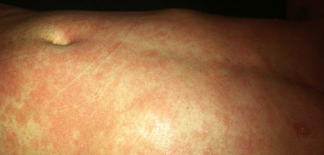 Prednisone Withdrawal Symptoms Rash