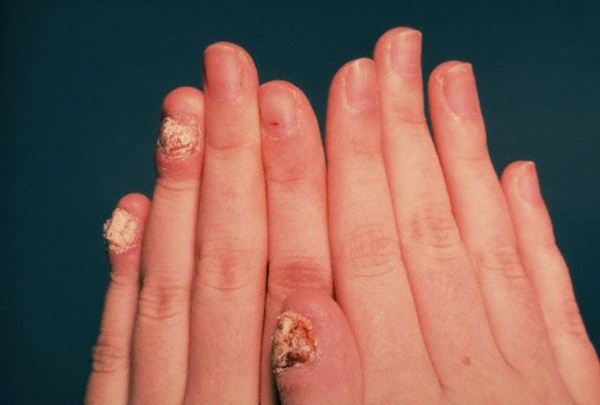 An infection with nail fungus may begin as a white or yellow spot under the