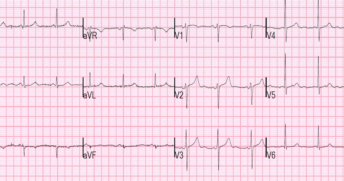 Dr. Smith's ECG Blog A 50something with severe chest pain and a normal ECG