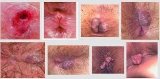 obat wasi obat wasir