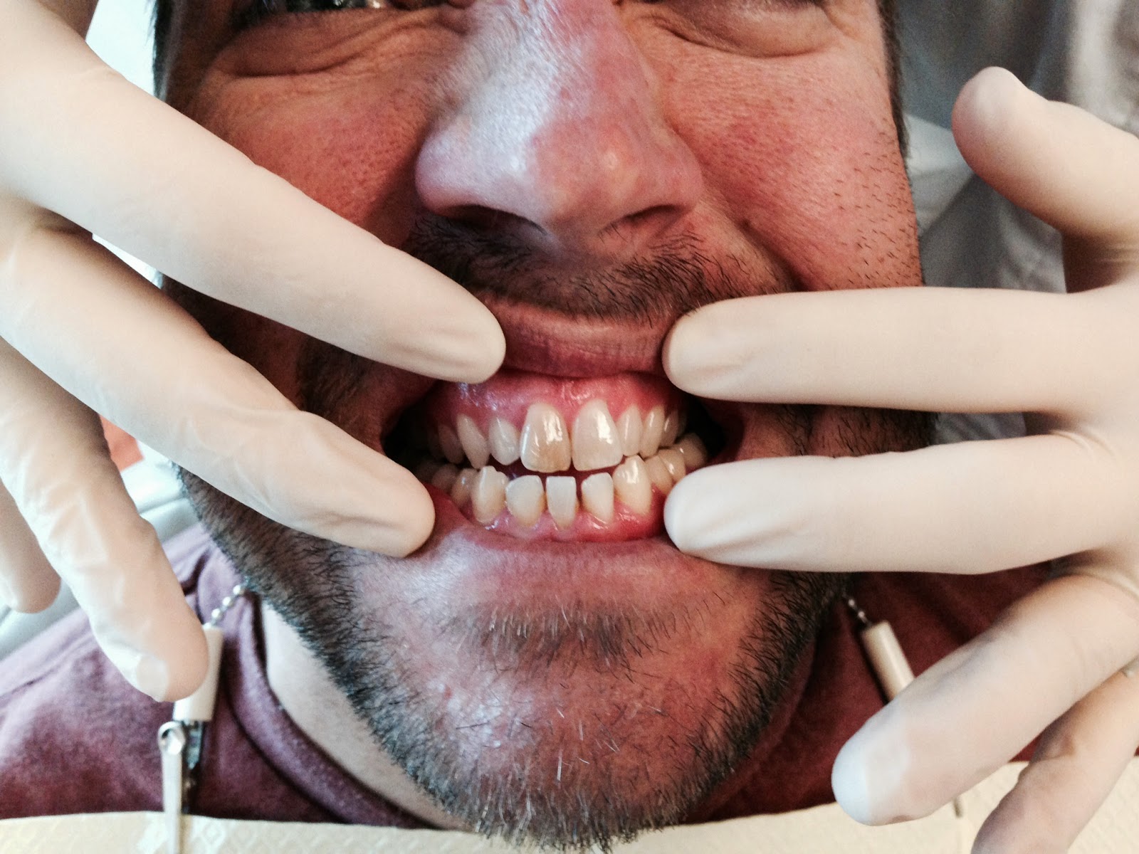 The Endo Blog Internal Bleaching of VITAL Teeth