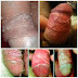 ANTIBIOTIK Sipilis di Apotik Khusus Herbal thumbnail