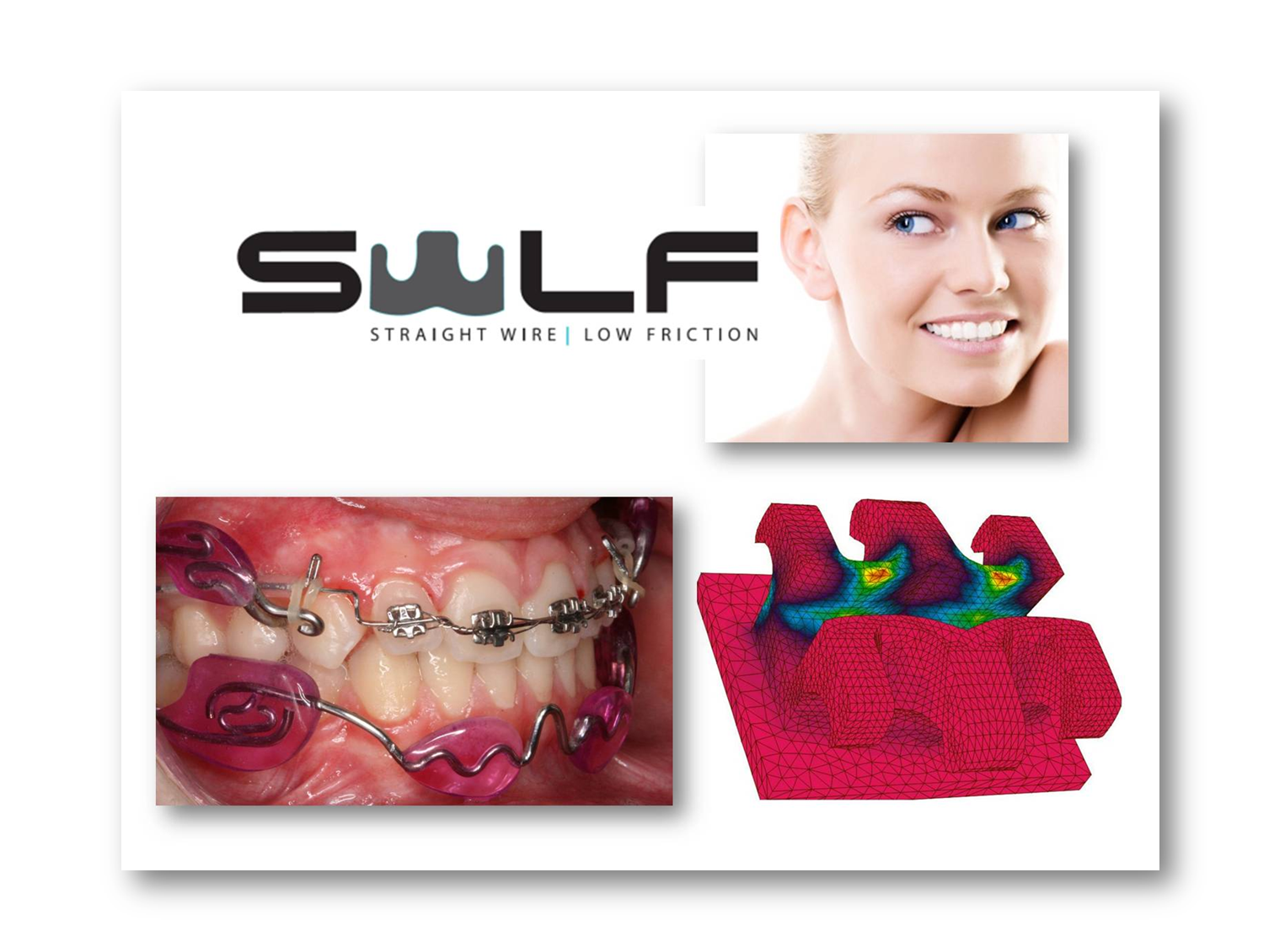 STRAIGHT WIRE LOW FRICTION TECHNIQUE Bienvenidos al nuevo blog de la