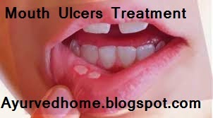 Mouth Sores Home Remedy