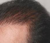 Hair Loss & solution