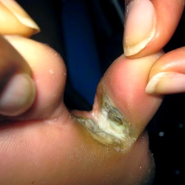 Del hongo de las uñas que es mejor el precio
