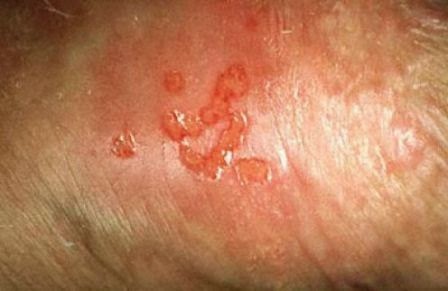 Reveal First Sign of Genital Herpes on Man