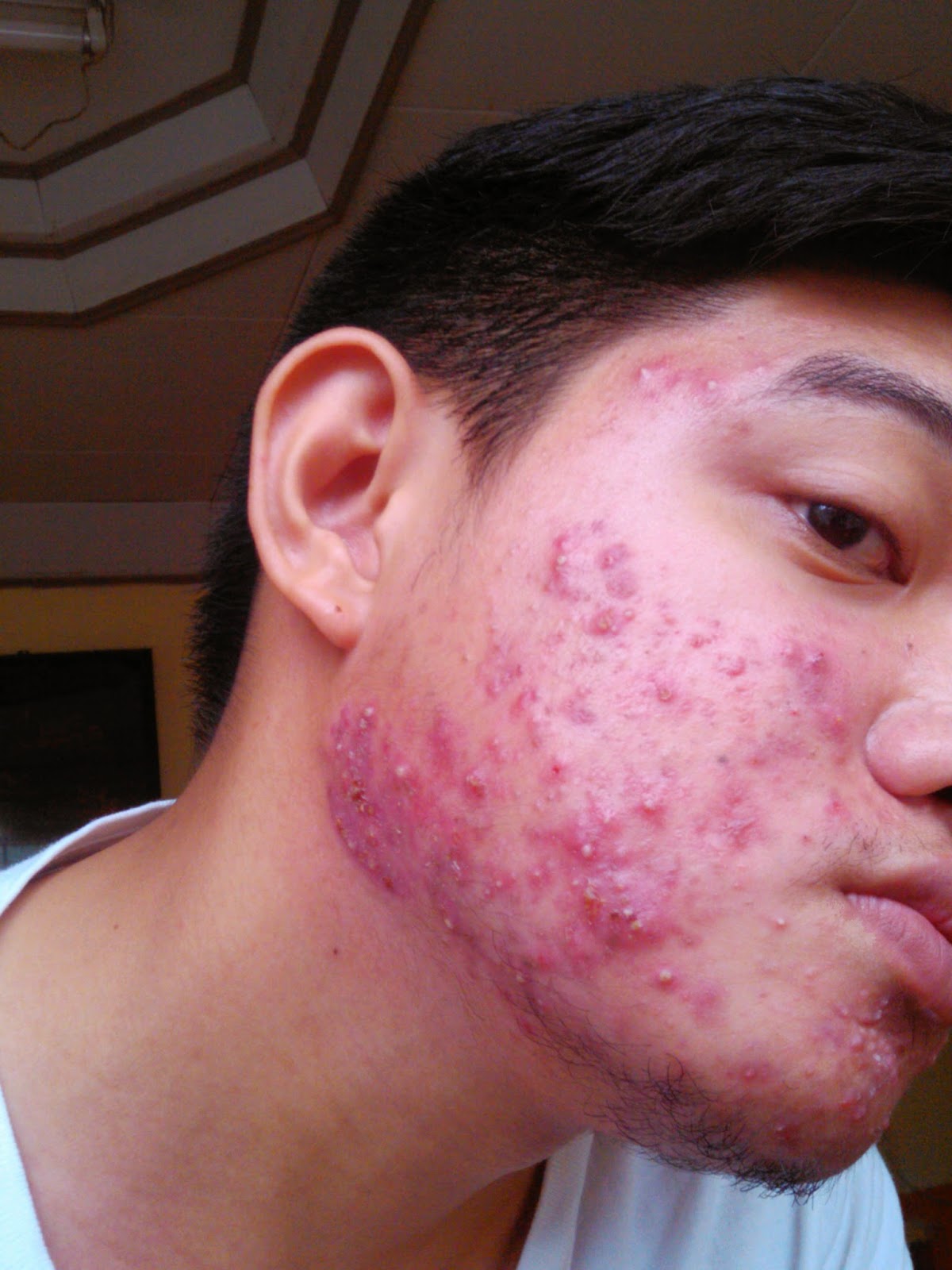 Disgusting Pimples - rkyezc4