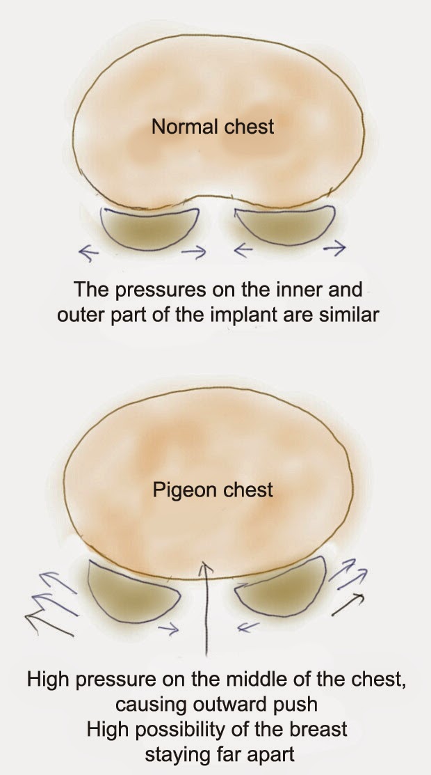 pigeon breast deformity hustler z serial number