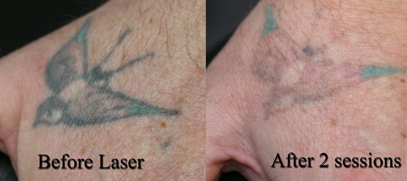 laser tattoo removal cost the story laser tattoo removal cost the story