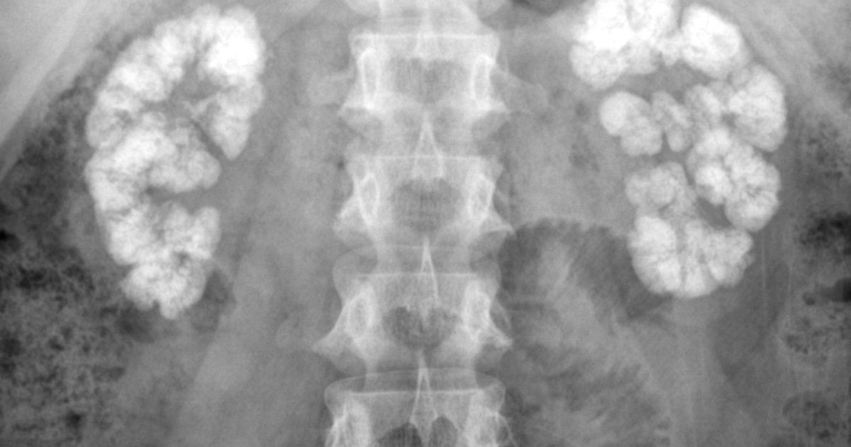 Medullary NephrocalcinosisPlain Film Sumer's Radiology Blog