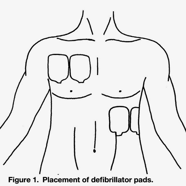 Double simultaneous defibrillators for refractory ventricular