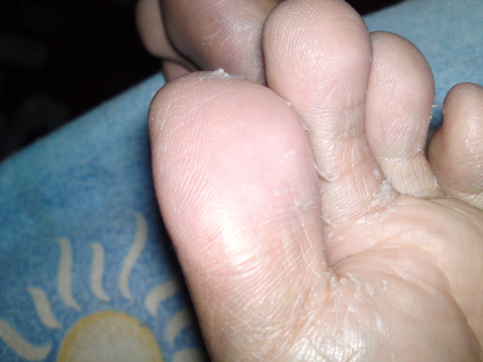 Feet Peeling Skin