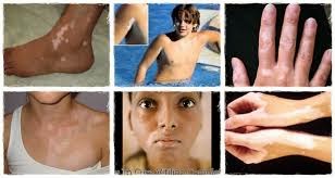 Vitiligo Home Remedy children,