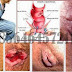 Obat Anti Inflamasi (Radang) Bengkak di Anus thumbnail
