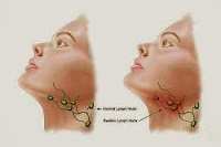 Cara Menyembuhkan Tumor Di Leher