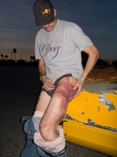 x-games injury