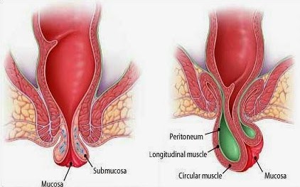 Image Obat Wasir yang Direkomendasikan Dokter