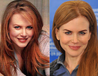 Nicole Kidman Plastic Surgery on Chatter Busy  Nicole Kidman Plastic Or Cosmetic Surgery