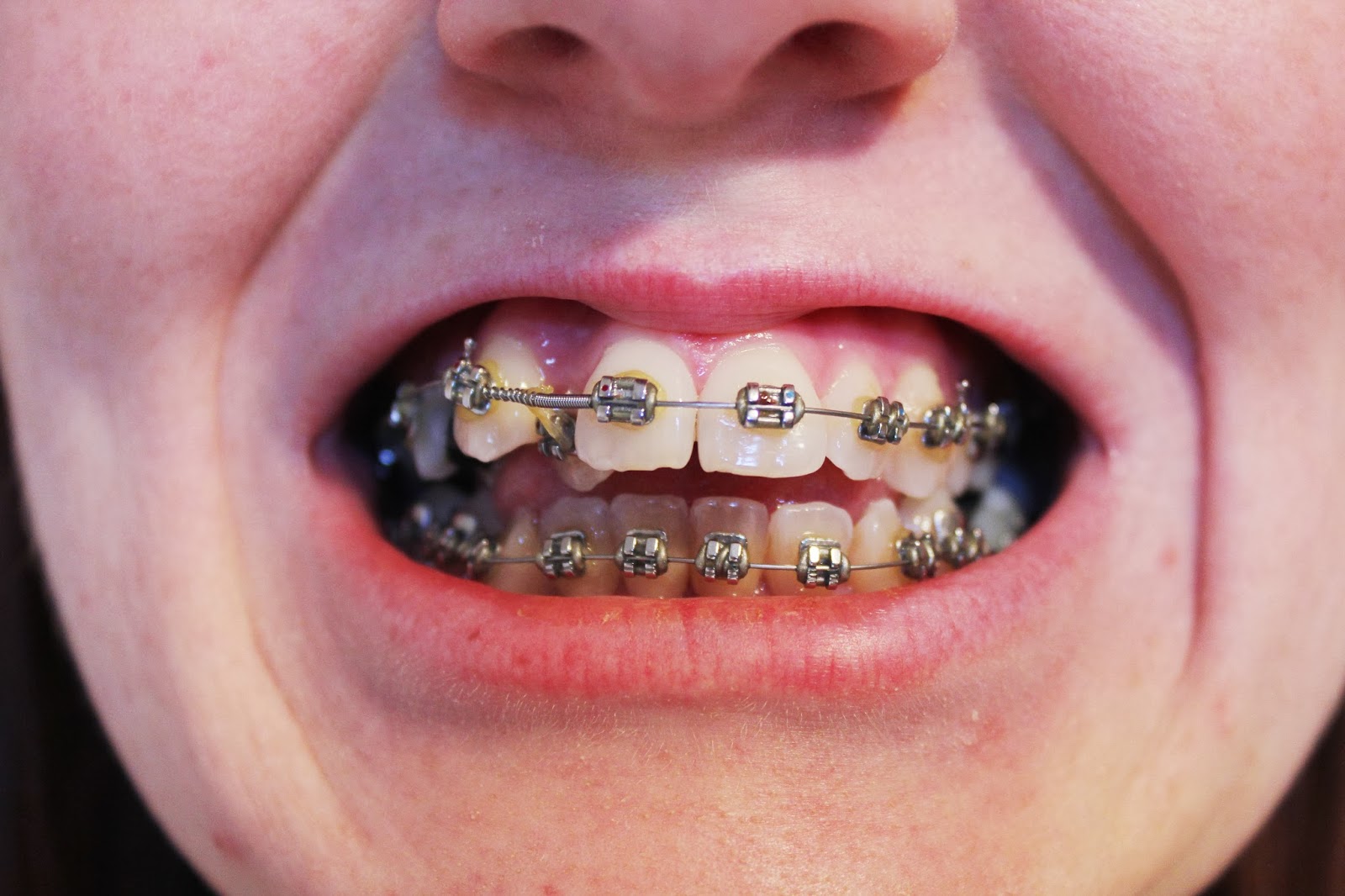 The brace lady 3 Months Update