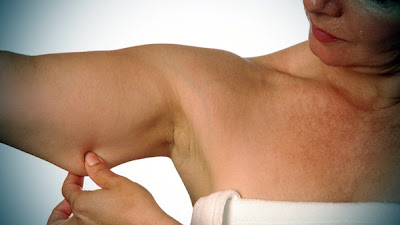 Upper Arm Lift Upper Arm Lift
