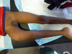 displaced femur fracture in a child