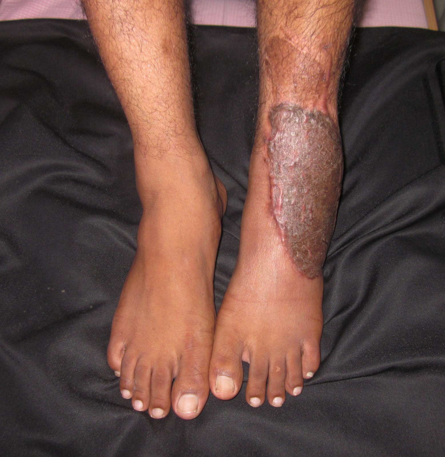 CRUSH INJURY FOOT OPEN ANKLE JOINT FREE LATISSIMUS DORSI MUSCLE