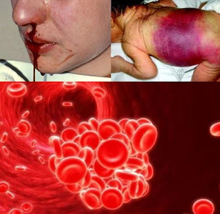 Apa itu hemofilia? Apakah penyebab penyakit hemofilia? Pengobatannya? Gb. Apa itu hemofilia? Apakah penyebab penyakit hemofilia? Pengobatannya?