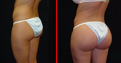Brazilian Butt Lift Before and After