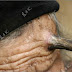 Hundred-year-old woman grows horn in forehead