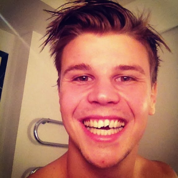 Dortmund’s Goalkeeper Hit the Post with his Face, Cracked Tooth 8 & 9