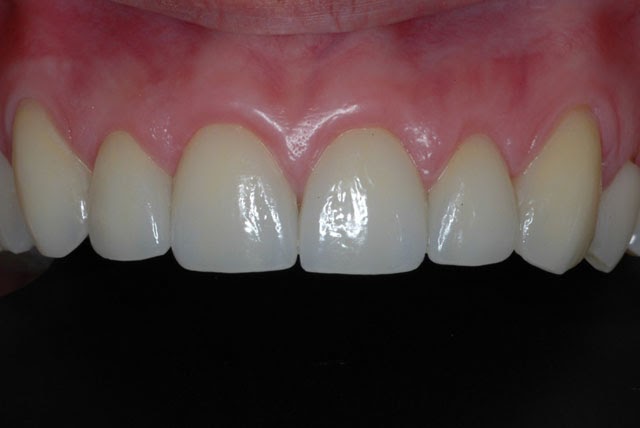 Brandus Blog: O que pode ser feito quanto às doenças das gengivas?