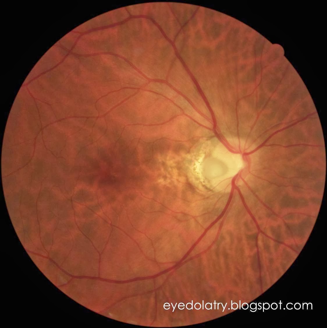 What's That in My Retinal Photo? Optic Nerve Pit Eyedolatry