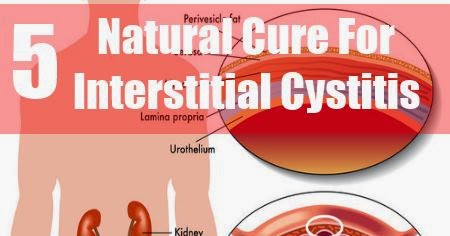 Best Natural Treatment For Interstitial Cystitis Best Natural Treatment For Interstitial Cystitis
