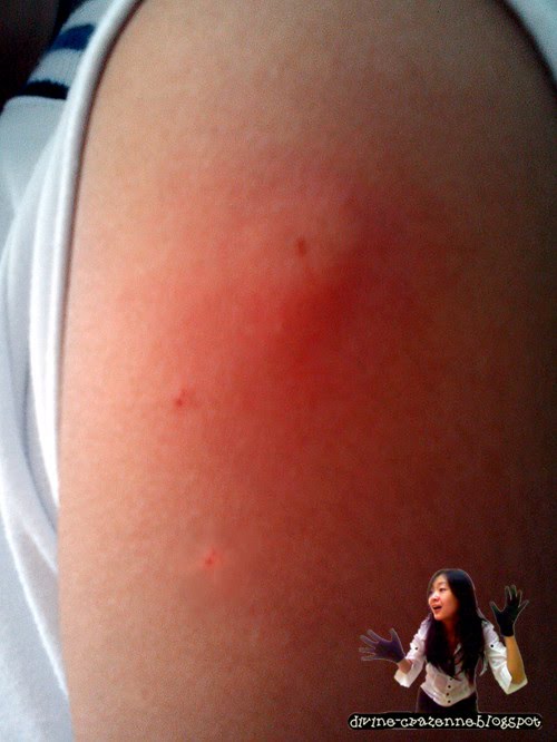 reaction to vaccine mmr vaccine side effects images reaction to vaccine mmr vaccine side effects images