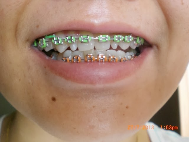 braces august