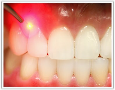 http://www.laserdentalclinicbangalore.com/Laser-Treatment.php