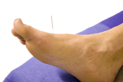 Acupuncture Weight Reduction  Not Only Needles