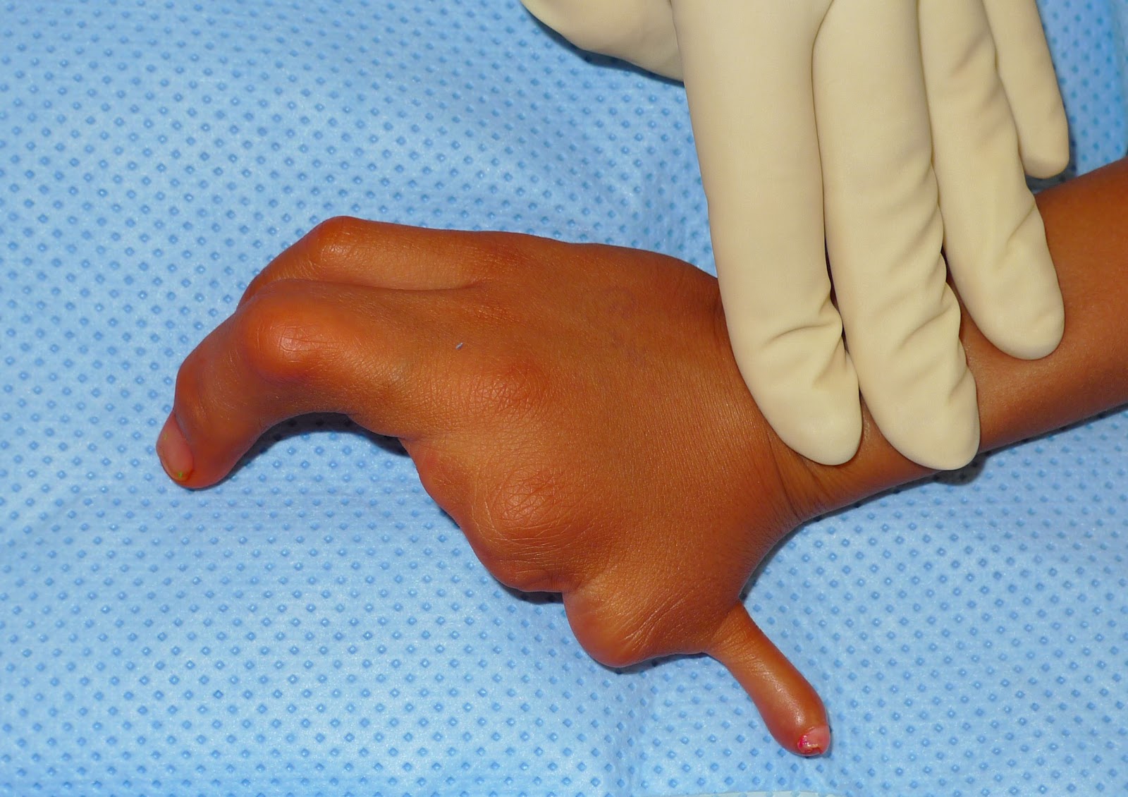 Why does my finger grow dumb Well find out Why does my finger grow dumb Well find out